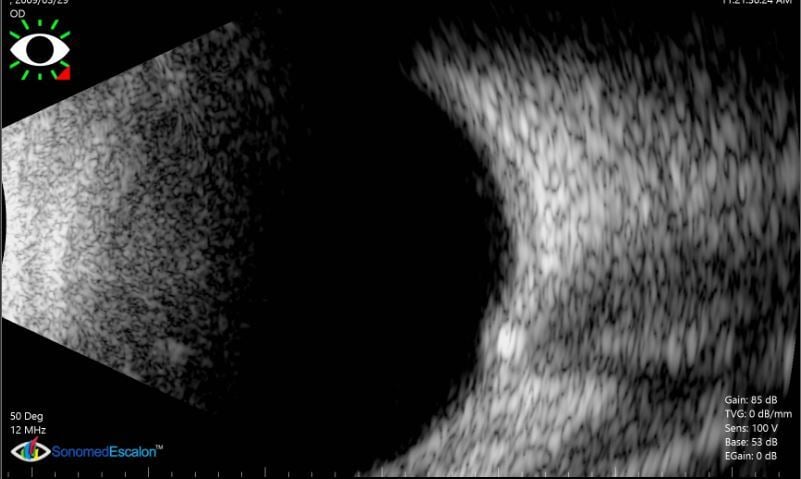 OCT Article Case Study Advanced OCT Diagnostics For Buried Optic oct-article-case-study-advanced-oct-diagnostics-for-buried-optic